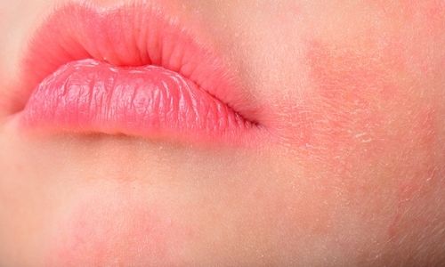 4 Pregnancy Skin Problems Plus How To Treat Them rosacea